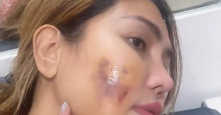 Luka di Pipi Dan Dapat Jahitan, Pedangdut Ratu Meta Alami KDRT